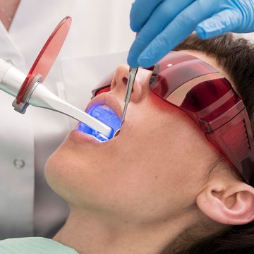 How to Fix Uneven Teeth Whitening for a Flawless Smile