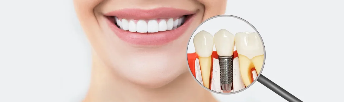 How Dental Implants Help Prevent Jawbone Loss After Tooth Loss