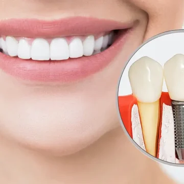 How Dental Implants Help Prevent Jawbone Loss After Tooth Loss