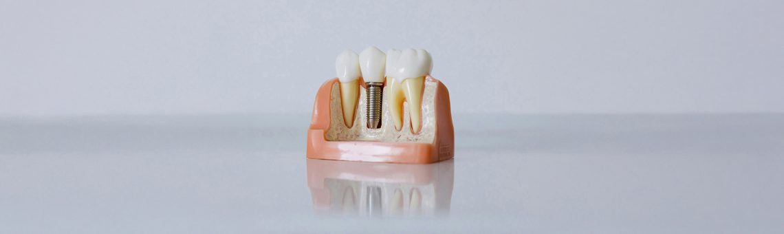 Key Factors That Influence the Longevity of Dental Implants in Burnaby