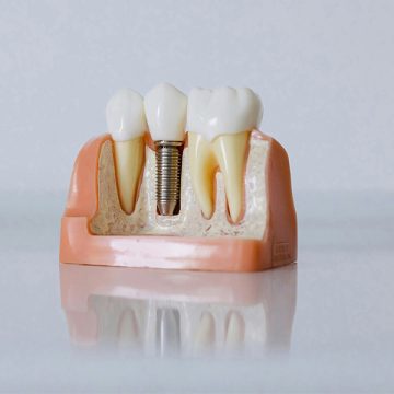 Key Factors That Influence the Longevity of Dental Implants in Burnaby